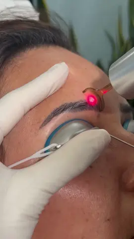 📸✨ Say goodbye to unwanted microbladed brows with the power of the Picoway Laser! 🌟 Our patient is getting one step closer to their dream brows with a gentle and effective laser tattoo removal treatment. 🖤✨⠀ ⠀ 🔍 The Picoway Laser targets ink particles with precision, breaking them down for natural elimination by your body. It’s a game-changer for those looking to refresh their look or correct previous brow work. ⠀#lasertattooremoval #picowaylaser #browgoals @beautytransformation #tattooremoval #miceoblading #skincare #flawlessbrows