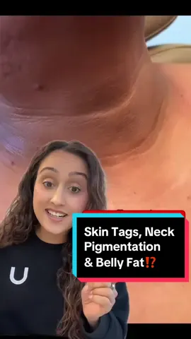 Neck pigmentation, skin tags, belly fat, cravings… do you know these are all signs of Insulin Resistance! #hyperpigmentation #skintags #pigmentation #insulinresistance #fyp #punjabi #viral 
