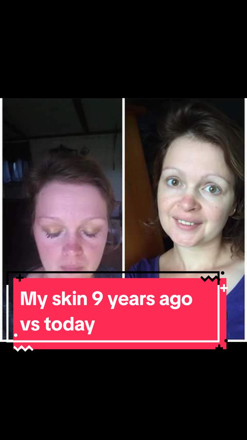 Are you over 40 and struggling with your skin? I turned my skin from tomato-red to what you see today! As a woman over 40, I know hydration is key. Drop 'skincare' in the comments for a free consultation! #skincare #skincareover40 #redskin #Rebeccasbeauties 