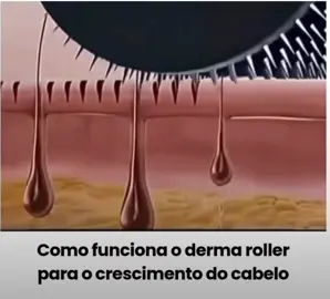 O dermaroller é uma ferramenta utilizada na terapia capilar que consiste em um rolo com microagulhas. O seu funcionamento baseia-se no princípio da microagulhamento, que estimula o couro cabeludo a promover o crescimento capilar. Quando o dermaroller é aplicado no couro cabeludo, as microagulhas penetram na pele, criando microlesões. Essas lesões desencadeiam um processo natural de cicatrização, que ativa a produção de colágeno e elastina. Esse aumento na circulação sanguínea e a renovação celular são fundamentais para fortalecer os folículos capilares e, assim, promover o crescimento de novos fios de cabelo. Além disso, o uso do dermaroller pode facilitar a absorção de produtos tópicos. A combinação do microagulhamento com esses tratamentos pode resultar em um aumento significativo na densidade e na saúde dos cabelos. #microagulhamento #calvicie #alopeciaandrogenetica #autoestima #quedadecabelo #saudecapilar #crisguilhemterapeutacapilar #santoandre #dermaroller 