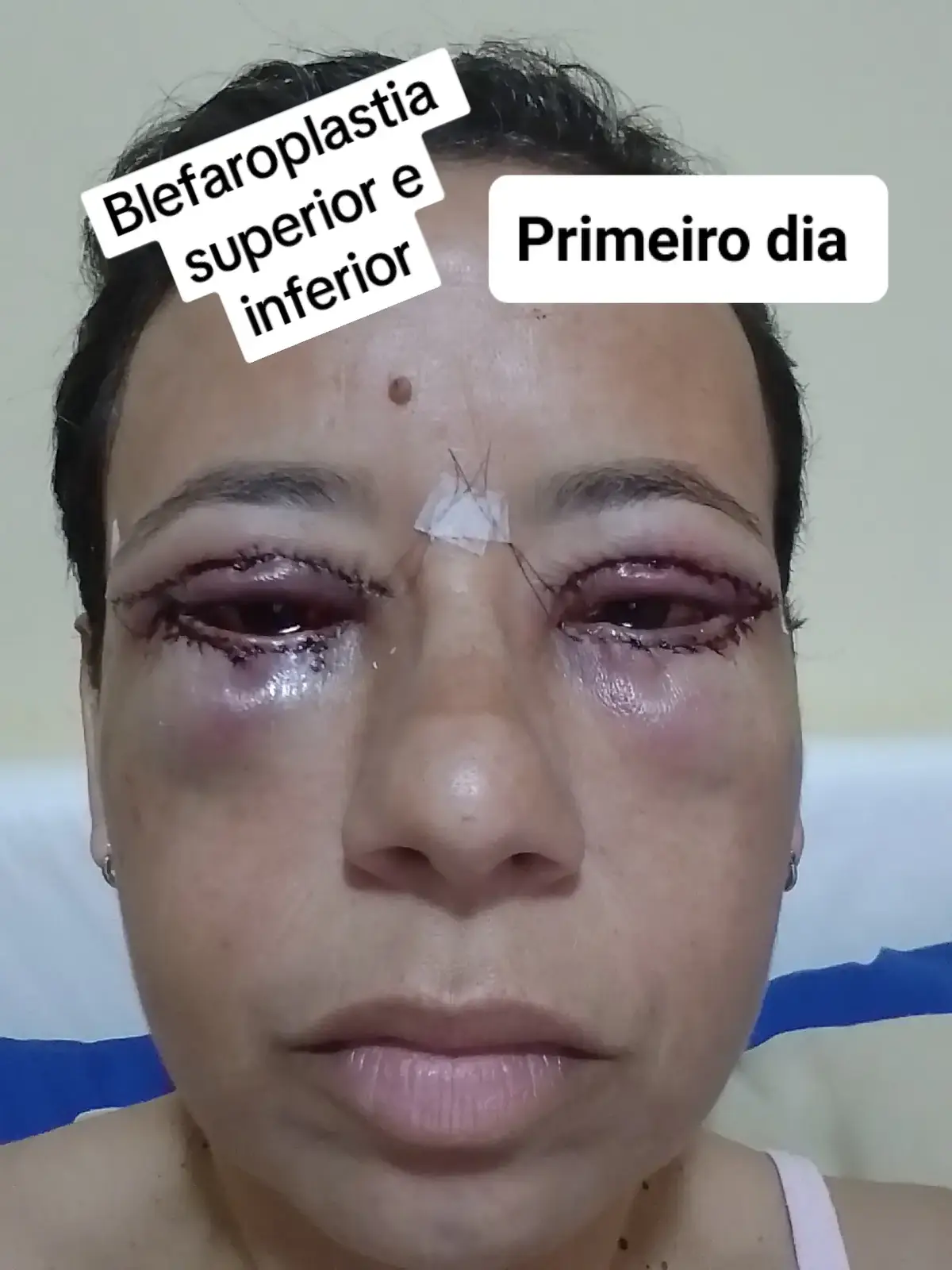 Aqui está o resumo da minha blefaroplastia.  Fiz superior e inferior. Minhas pálpebras superiores estavam caindo por cima dos olhos,além de estar esteticamente feio,horroroso...rsrs...Estava diminuindo meu campo de visão,e eu já não enchergo bem...kkk Fiz pelo SUS,fiquei um ano na fila do SISREG. Mas valeu a pena 🙏 #blefaroplastia #cicatriz #recuperacion #posoperatorio #satisfeita #feliz #autoestima #cirurgiaplastica #procedimentosesteticos #estetica #emponderamentofeminino #escolhas 