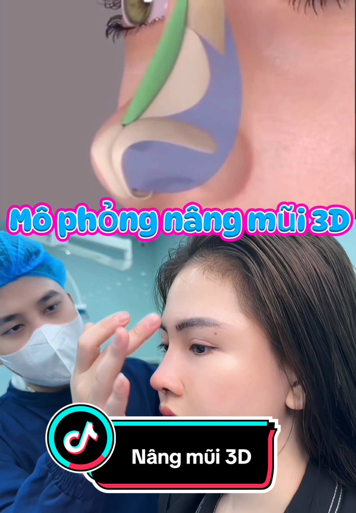 Mô phỏng Nâng Mũi 3D #mophong3d #drduyha #nangmui #nangmuisline #nangmuicautruc #xuhuongtiktok2024 #lamdep #PTTM #thammy #viral #surgery #fyp 