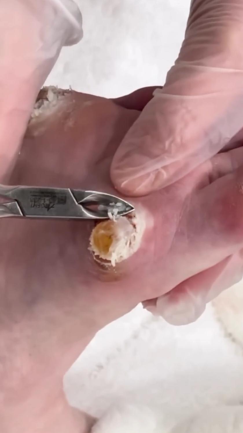 GIANT HORN FOOT REMOVAL 😲 😱 #footcare #Satisfying #podiatrist #podiatry 