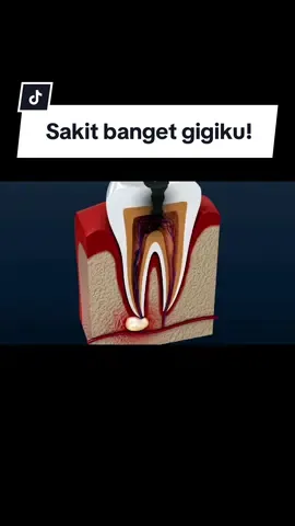 Siapa yang pernah sakit gigi parah sampai ga bisa beraktivitas? 😷 Jangan seneng dulu kalau udah ga sakit lagi! Bisa jadi itu tandanya saraf gigimu udah mati 🥹 Yuk sebelum sakit dan harus jadi ompong, ke dokter gigi tiap 6 bulan sekali. Ke dokter gigi ga harus nunggu sakit ya 🤗 #sakitgigi #cabutgigi #psa #doktergigi #gigiberlubang  