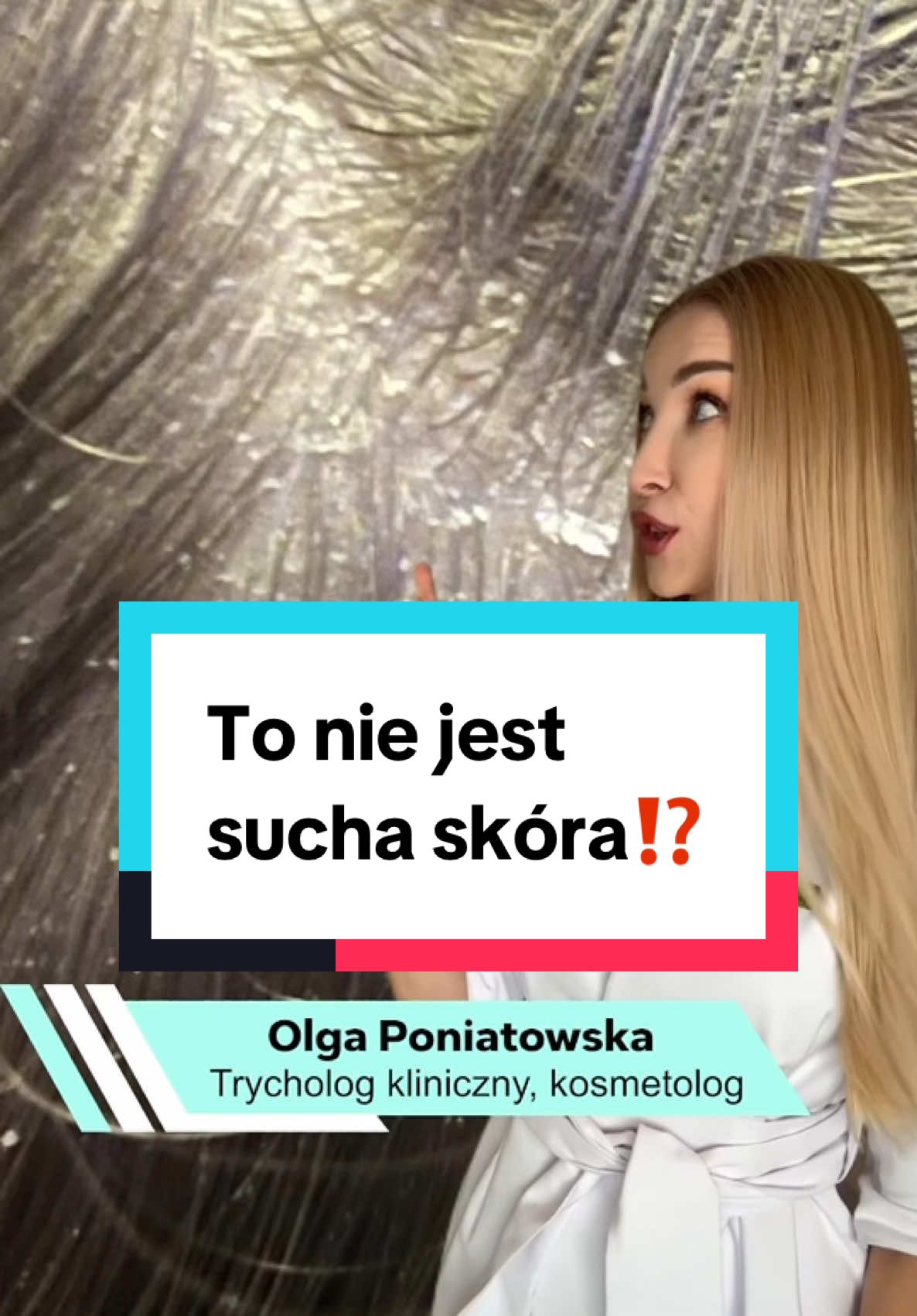 ⁉️To nie jest sucha skóra⁉️ ✅ W przypadku łuski, ktora pojawila się na suchej, wrażliwej, napiętej i swędzącej skórze głowy (również przy ŁZS i łuszczycy) szukaj ▶️  olei peelingująch do skóry głowy z kwasem salicylowym👌 ✅ W przypadku łupieżu suchego lub tłustego szukaj ▶️ peelingów oczyszczających z kwasem salicylowym i piroctonem olaminy 👌  ❌ Do skóry głowy używaj peelingow DO SKÓRY GŁOWY☝️ ❌ Nie trzymaj peelingu dłużej niż zaleca producent.  #łupież #łupieżtłusty #łupieżsuchy #łuszczącaskóragłowy #łuskanagłowie #trycholog #peelingskórygłowy #peelingskoryglowy 