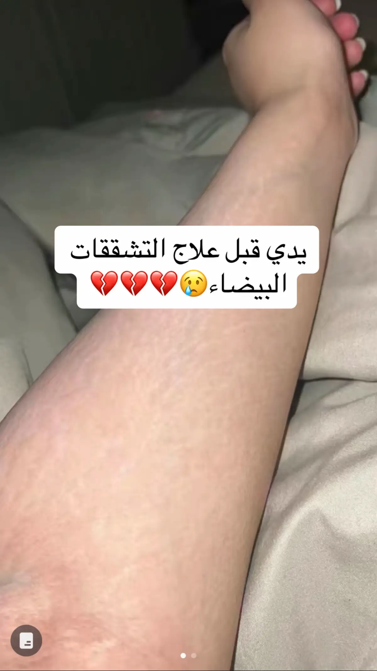 استمرو بنات وتشوفون نتايج تجنن❤️❤️#foryou #explore #stretchmarks #اكسبلورexplore #الشعب_الصيني_ماله_حل😂😂 