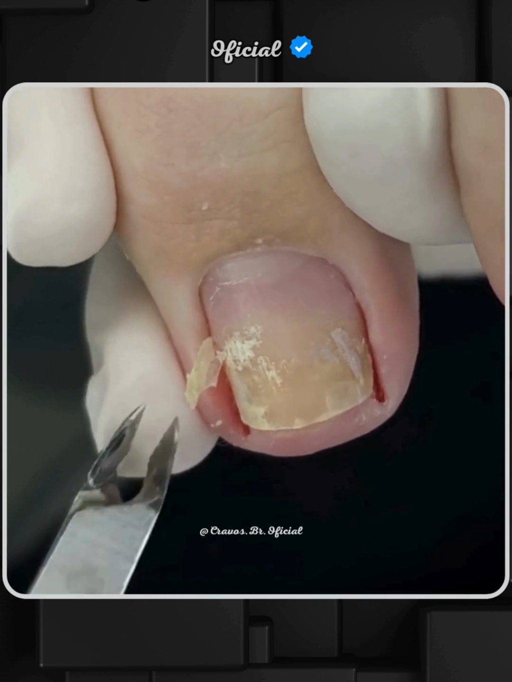 Tratamento 1036 - #Unhas #Pedicure #Podologia #Tratamento #Pé 