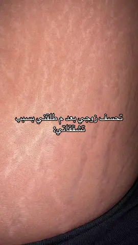 م شاء الله زيت ايلا مسح التشققات مسح😭😭#زيت_التشققات_ايلا #foy #اكسبلور #foryou #حمل #زواج #علامات_التمدد #نخف #fypシ 
