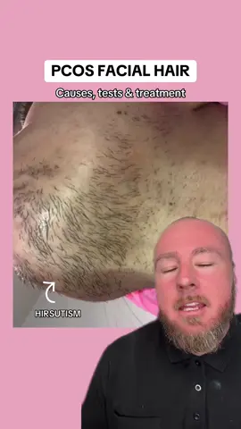 Hirsutism, or the excess growth of thick / dark facial and body hair is one of the most common symptoms of PCOS. Due to its highly visible nature, it's also one of the most emotionally impactful symptoms of PCOS. Hirsutism is the result of high levels of androgen hormones, which causes hair in areas of the body with higher androgen receptors to grow faster, thicker and darker hairs. The most common areas are the face, jaw, neck, chest, belly, and back. There are many PCOS facial hair treatment options; - Shaving is instant but it obviously doesn't resolve the underlying hormonal problem - Laser removal is popular. Opinions are often split (I'd love to hear yours?) - Medications such as spironolactone or finasteride are often prescribed (again, I'd love to hear if you have any thoughts on these?) There are also many things you can do naturally; - Spearmint tea - Zinc with saw palmetto - Pumpkin, chia or flax seeds  Also, if you do have insulin resistance, having this as the focus of your plan is key to naturally balancing androgens. 👉 To join NOVUM or get the MOST EFFECTIVE supplements click the link in my bio #pcos #pcosweightloss #pcosawareness #pcosdiet #pcossupport #pcosjourney The information in this post is solely for general purposes only. It is not intended to be medical advice. Always consult with your doctor for your individual needs.