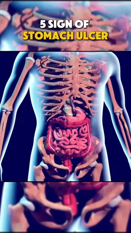 5 sign of Stomach Ulcer#stomachproblems #stomachissues #stomach #ulcer #ulcerativecolitis #sensation #nausea #bleeding #headache #bloating #gas #frequent #digestion #heart #medical #medicalstudent #medicalhumor #healthy #healthcare #medievaltiktok 