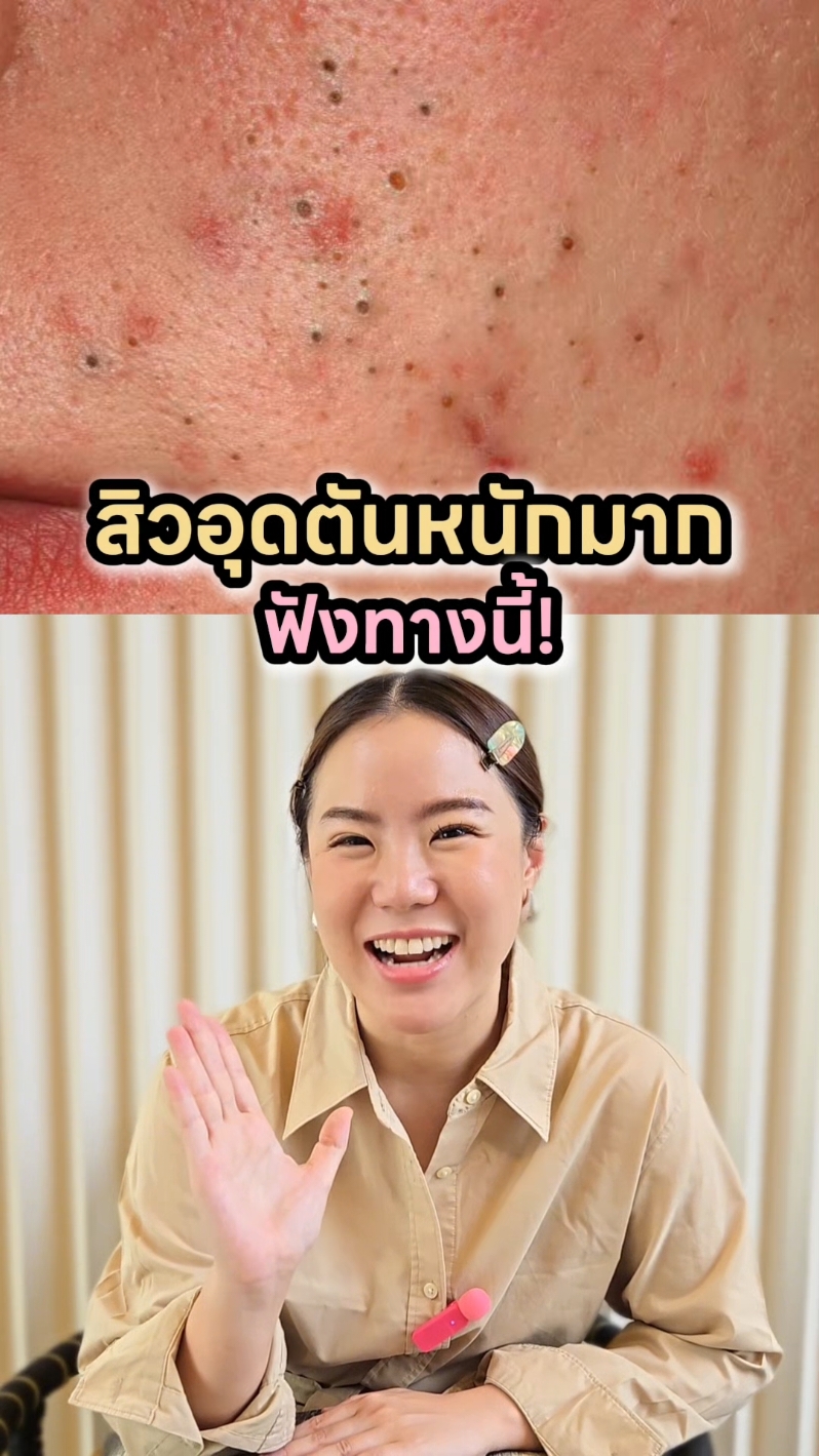 ใครสิวอุดตันหนักๆ...เซฟคลิบนี้ด่วนน!! #สิว #สิวอุดตัน #รีวิวบิวตี้ #รักษาสิว #หมอผิวหนัง 