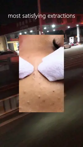 #pimple #acne #comfortable #blackhead #pimplepopper #viral #tiktok 