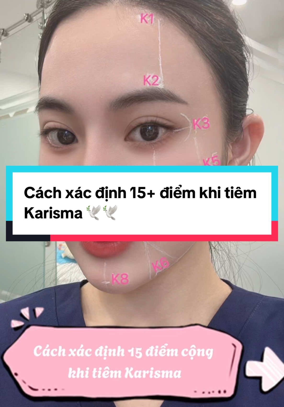 Kĩ thuật tiêm K15+ - Cách xác định 15 điểm tiêm Karisma. ❤️#karisma #trehoada #trehoakhuonmat #tangsinhcollagen #Filler #botox #PLLA #xuhuong2024 