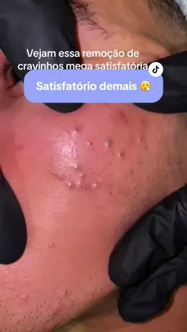 Satisfatório demais 🥹 #pimple #cravoseespinhas #cravingsatisfied #cravossatisfatorios #removendocravos #videossatisfatorios 