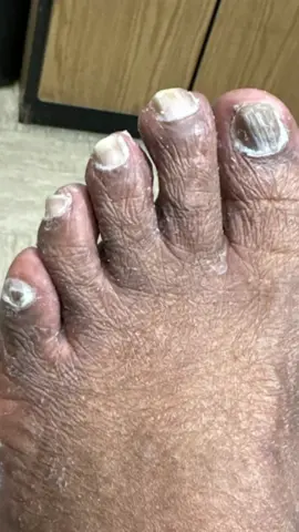 Fungal nails and athlete’s foot are curable #podiatry #feet #footcare #fungaltoenails #athletesfoot #fungalinfection #doctorsoftiktok #podiatristoftiktok #feetofticktock 