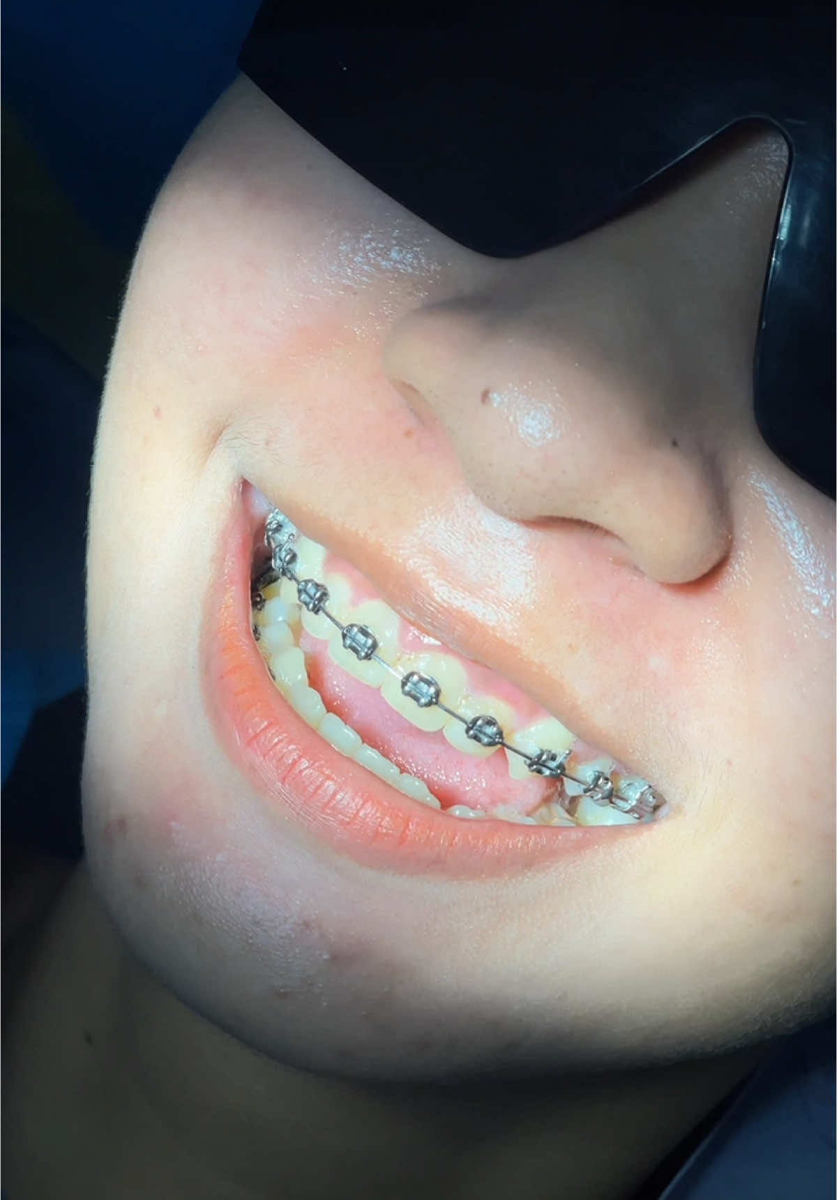 ខែនេះសុំ black ម្តង #brightsmiledentalhospital #foryouu #braces 