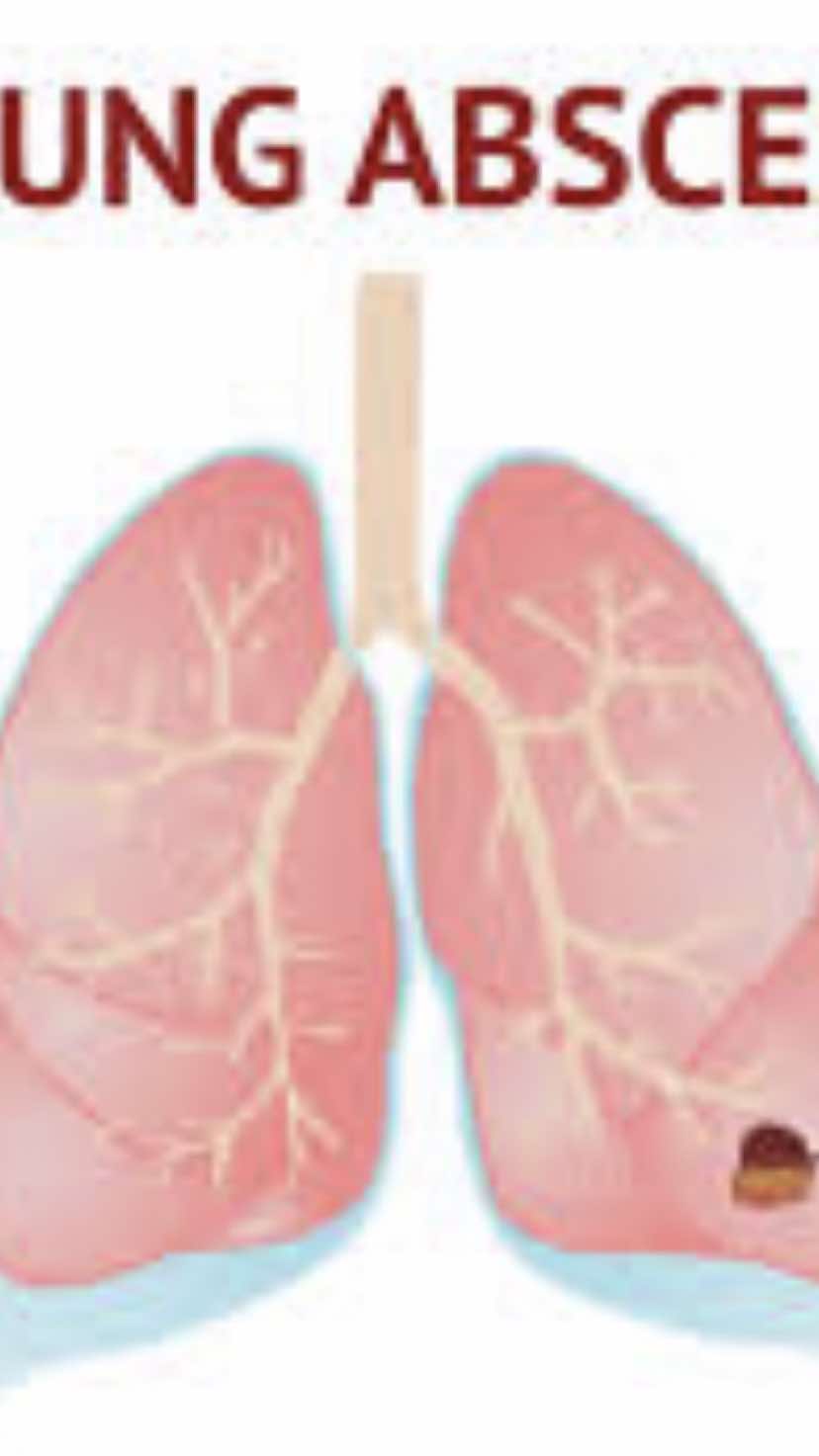 #fyppppppppppppppppppppppp #medcine #newgizauniversity #danaelamin12 #طبيب_تيك_توك #viral_video #lung #pulmonary #abscess #newgizauniversity #ngu #senior #year5 