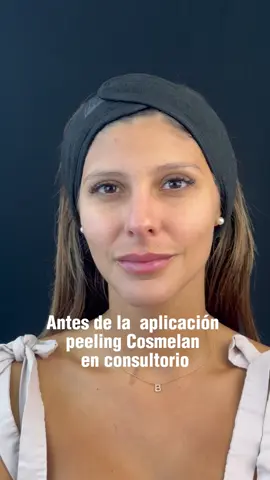 Hace una semana comencé el #Cosmelan de @mesoestetic.venezuela y me está cambiando la vida, una vida sin mancha en el bozo🥹💕 Estoy muy feliz, notas el cambio?  #melasma #melasmatemtratamento #melasmatreatment #cosmelan1 #Venezuela #Caracas #beauty #manchas #cosmelanpeel #Venezuela #manchasenelbigote #bozo 