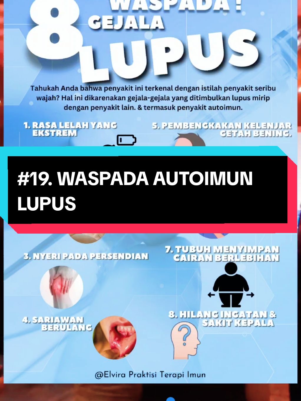 8 TANDA LUPUS : Lupus adalah penyakit autoimun inflamasi kronis yang disebabkan oleh sistem imun tubuh yang bekerja dengan keliru, memiliki julukan penyakit seribu wajah karena kelihaiannya dalam meniru gejala penyakit lain.  Tiga gejala utama yang umumnya selalu muncul, yaitu: 1. Rasa Lelah yang Ekstrem 2. Ruam pada Kulit Ruam kulit yang menyebar pada batang hidung dan pipi, istilah medis ruam kupu-kupu (butterfly rash) karena bentuknya yang mirip sayap kupu-kupu. 3. Nyeri pada Persendian Nyeri di tangan dan kaki, dapat berpindah dengan cepat dari sendi satu ke sendi lain.  - Sariawan berulang. - Demam tinggi (38 derajat Celsius atau lebih). - Tekanan darah tinggi. - Pembengkakan kelenjar getah bening. - Sakit kepala. - Rambut rontok. - Mata kering.  - Sakit dada. - Hilang ingatan. - Napas pendek akibat inflamasi paru-paru, dampak ke jantung, atau anemia. - Tubuh menyimpan cairan berlebihan, sehingga terjadi gejala, seperti pembengkakan pada pergelangan kaki - Jari-jari tangan dan kaki yang memutih atau membiru jika terpapar hawa dingin atau karena stres (fenomena Raynaud) #lupus #lupuswarrior #imun #autoimun #autoimunindonesia #terapiimun #imunoterapi 