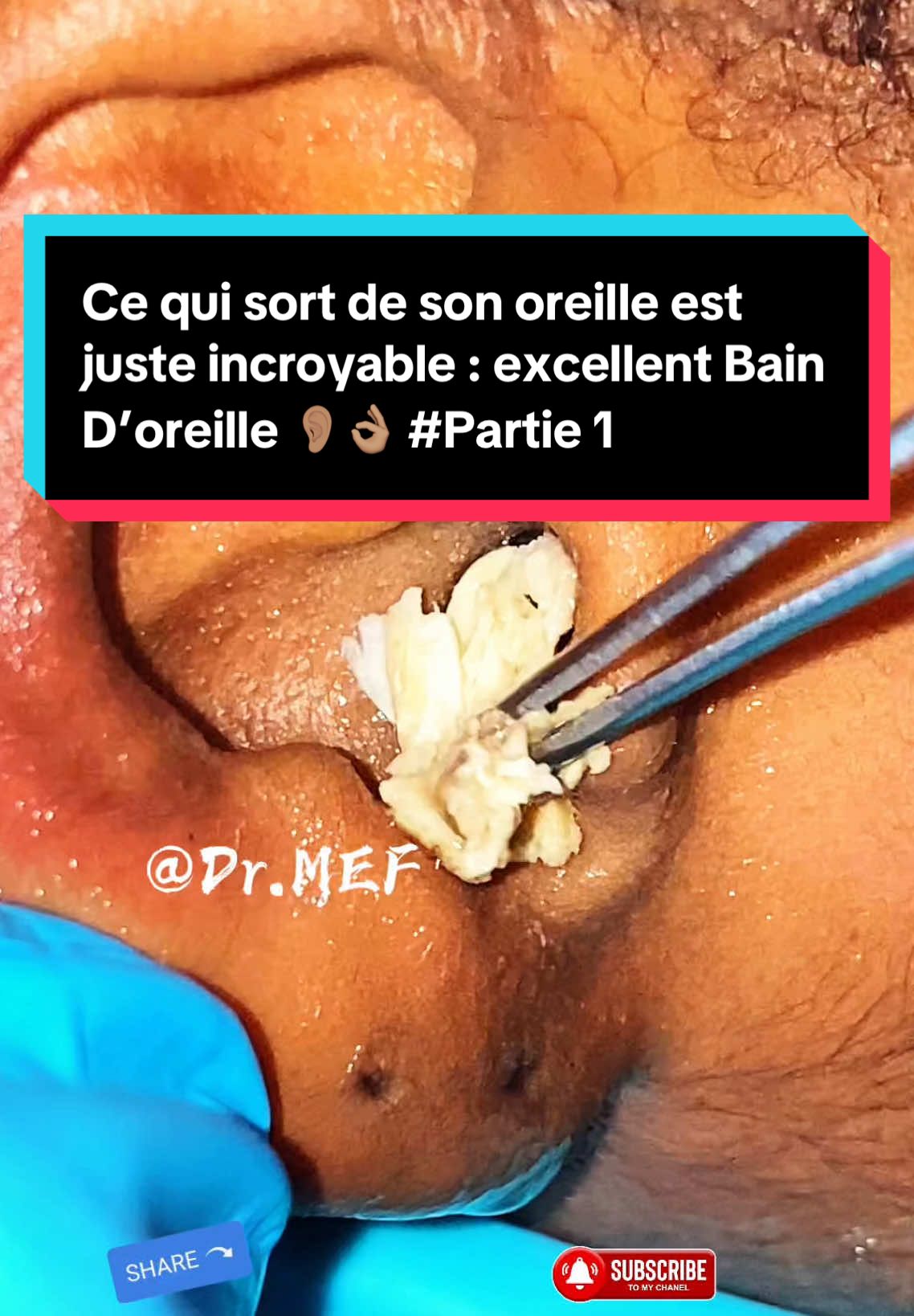 Énorme bouchon de cérumen / extraction / bain d’oreille 👂🏽👌🏽 Partie 1 #fypシ゚ #ear #fyp #france #canada_life🇨🇦 #pourtoi #foryour #foryoupage❤️❤️ #camerountiktok🇨🇲 #usa🇺🇸 #following #mefbrown 