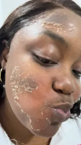 As manchas na pele podem mexer muito com a nossa autoestima, mas a boa notícia é que existem tratamentos eficazes para clarear e uniformizar o tom da sua pele. O peeling Natural é um dos procedimentos mais indicados para renovar a pele, tratar manchas e estimular o colágeno, deixando a pele mais uniforme, luminosa e saudável. ✨ Se você sente que as manchas estão afetando sua confiança, o peeling Natural pode ser a solução para recuperar a vitalidade da sua pele.  Vamos conversar sobre o tratamento mais adequado para você? 💆♀Entre em contato e agende uma consulta! #lilubody a #peeling #peelingnaturalzena #clareamentodemanchas