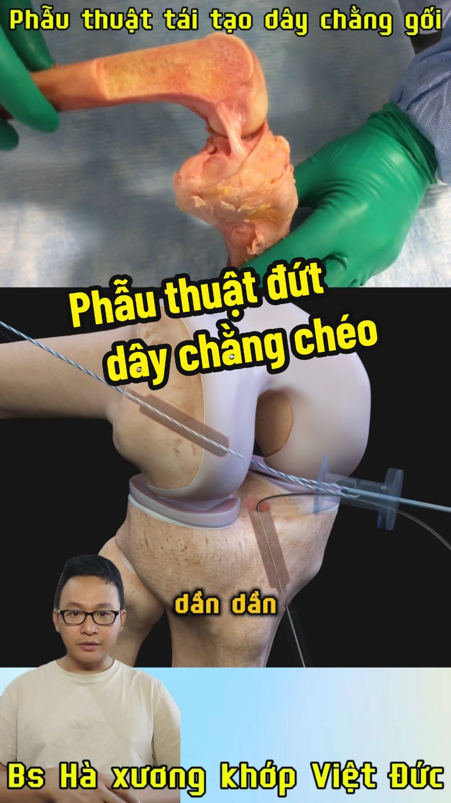 Phẫu thuật nội soi tái tạo dây chằng chéo trước bằng gân chân ngỗng ( Gân Hamstring ) kĩ thuật All-in-side (Tất cả bên trong ) hiện đại và tốt nhất hiện nay. Dây chằng chéo trước cũng như dây chằng chéo sau thường không thể tự liền nên sẽ phải tái tạo lại bằng cách sử  dụng một đoạn gân của chính cơ thể, tết thành 1 đoạn gân mới.Đoạn gân này sẽ được luồn vào các đường hầm xương đùi, xương chày và dần dần xương sẽ đến đóng chặt 2 đầu dây chằng mới. #phauthuatnoisoidutdaychang #noisoitaitaodaychang #dutdaychangcheotruoc #dutdaychangcheo #dutdaychang #noidaychang #taitaodaychang #dutacl #bshavietduc 