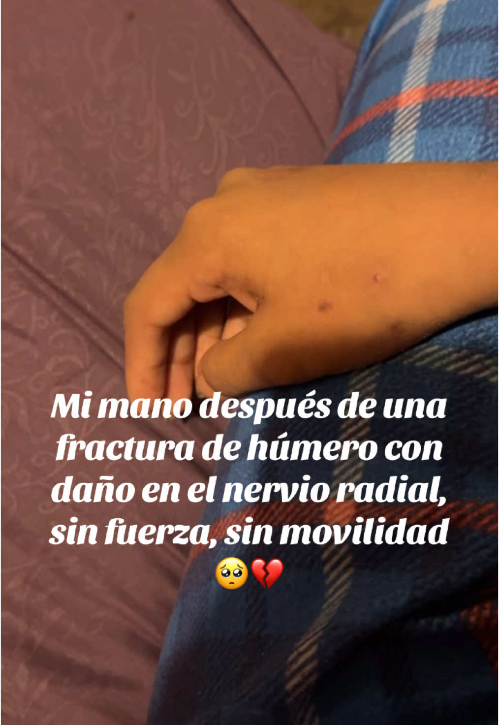 La peor batalla😭💔 #fractura #humero #nervioradial #lesion 