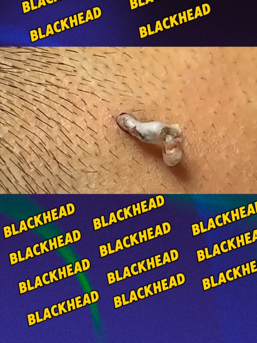 CRAZY BLACKHEAD REMOVED #blackheadsremoval #satisfyingvideo #blackhead #blackheads 