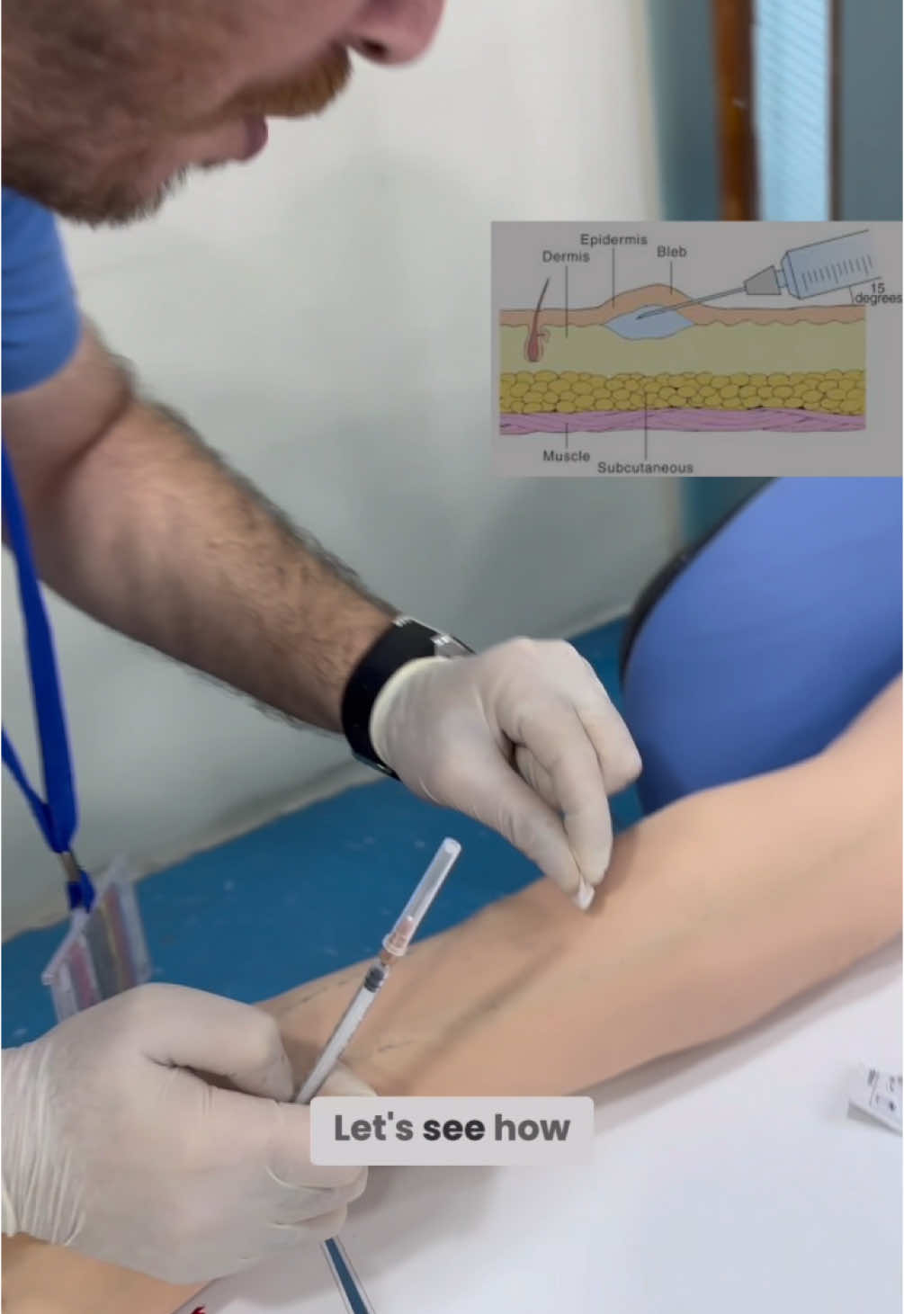 تعلم اعطاء ابرةفحص السل او الابر تحت الجلد   #‏subcutaneous #injection #InsulinSupport #diabetes #explore #explorepage #trendingreels #fypシ゚ #learning #health #Education #reelsviralシ