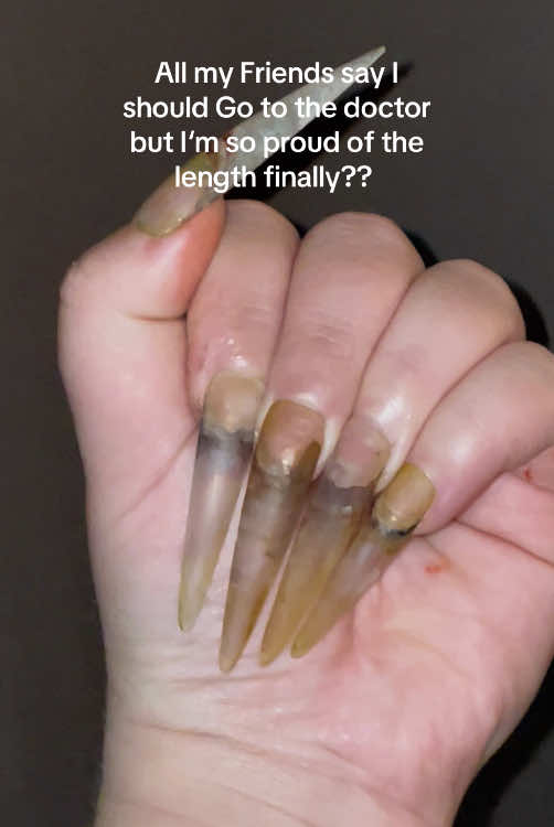 Like… should i go tho? Starting to get worried:/  . .  Hand painted xxl press on nails referencing dirt, funghal + bacterial infection 🧚🏻‍♂️  . #nailart#naturalnails#longnails#longnailsproblems #long #nails#nail #naildesigns #naildesign #nailtech#nailartist #naildesigner#nailarttutorial #xxlnails #xxlnailset #presson#pressons#pressonnails #pressonnails 