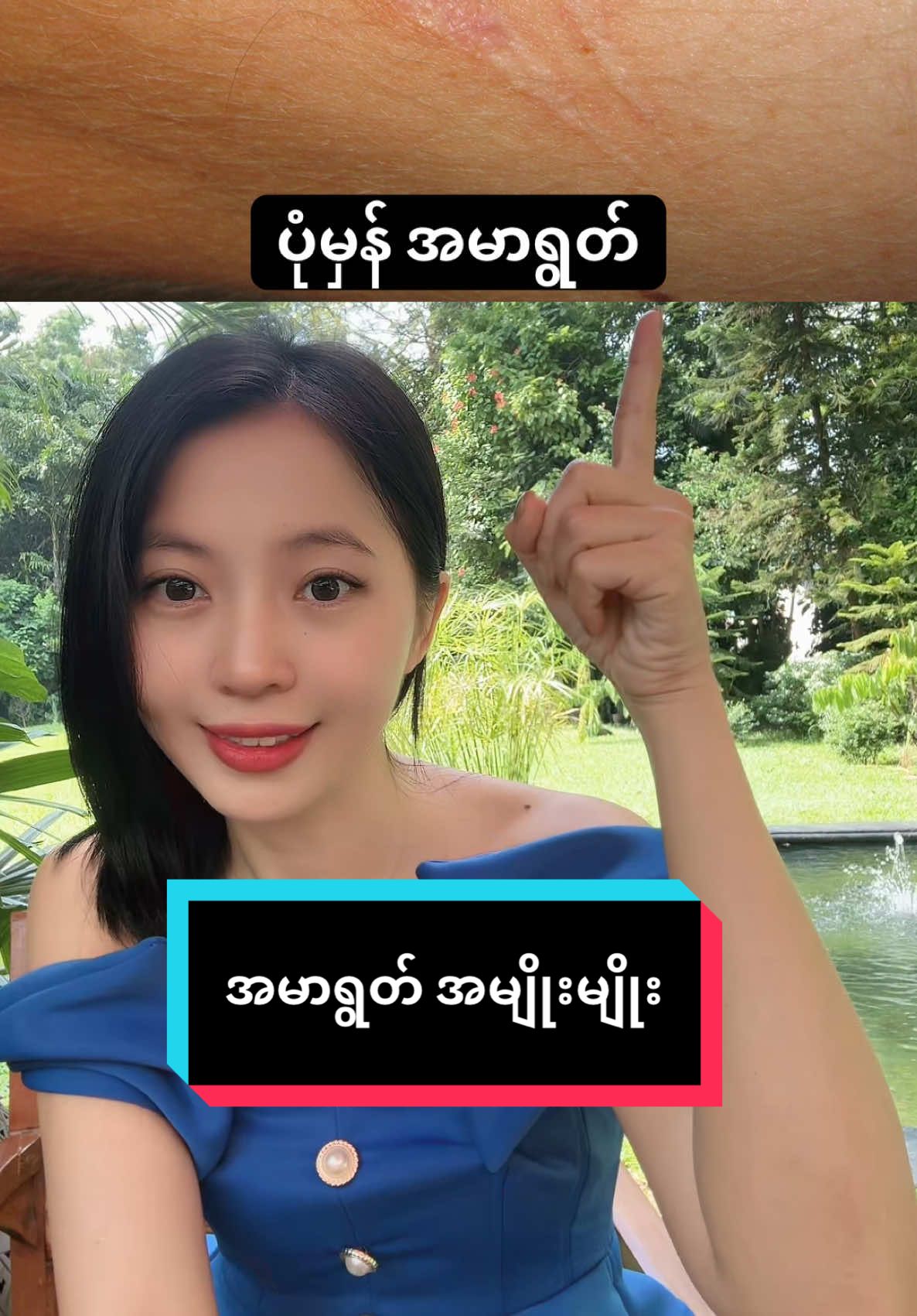 အမာရွတ် #scar #hypertrophicscar #keloid #scartreatment #skincare #bodycare #SkinCare101 #doctor #plasticsurgeonsoftiktok #drthe #fyp #fypviralシ #1m #အမာရွတ်တွေပျောက်ချင်သူတွေ #myanmartiktok🇲🇲🇲🇲 