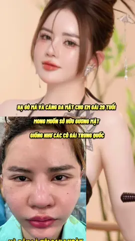 KẾT QUẢ 3 THÁNG CỦA EM GÁI 29 TUỔI HẠ GÒ MÁ VÀ CĂNG DA MẶT MONG MUỐN SỞ HỮU GƯƠNG MẶT NHƯ CÁC CÔ GÁI TRUNG HOA#phauthuatthammy 