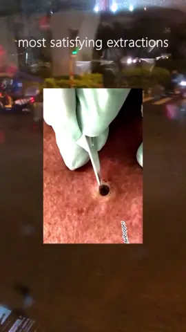 #pimple #acne #comfortable #blackhead #pimplepopper #viral #tiktok