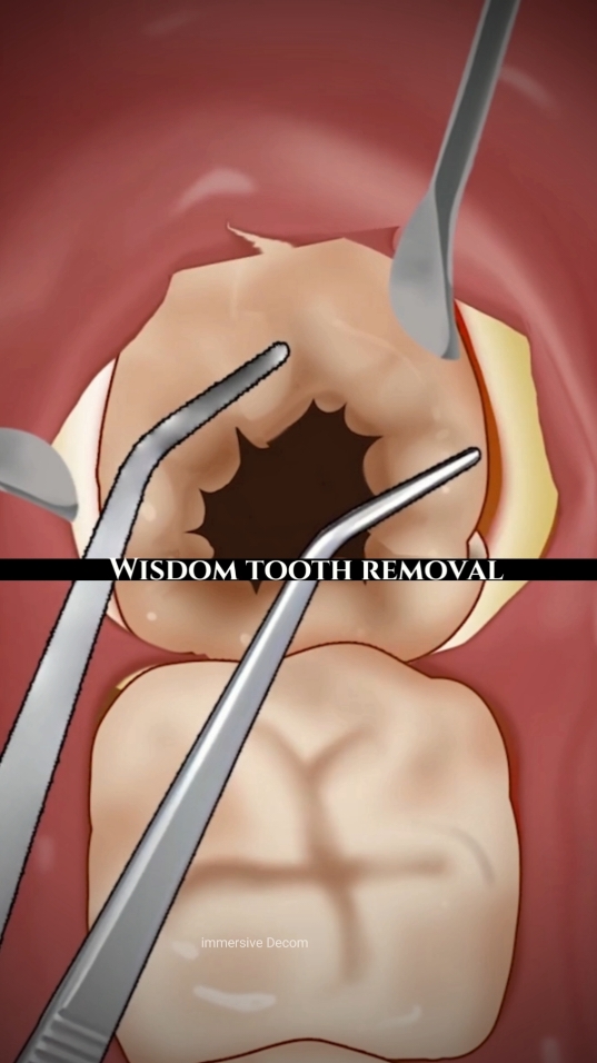 Wisdom tooth removal! #teeth #medical #care #satisfying #immersive #removal #treatment #asmr 