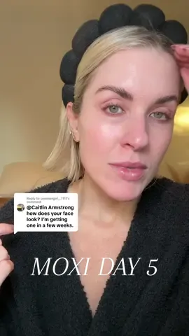 Replying to @summergirl__1111 Moxi Update Day 5! healing and looking gooood😭 ugh the glow post laser is the BEST! #moxi #moxilaser #skincare #facial 