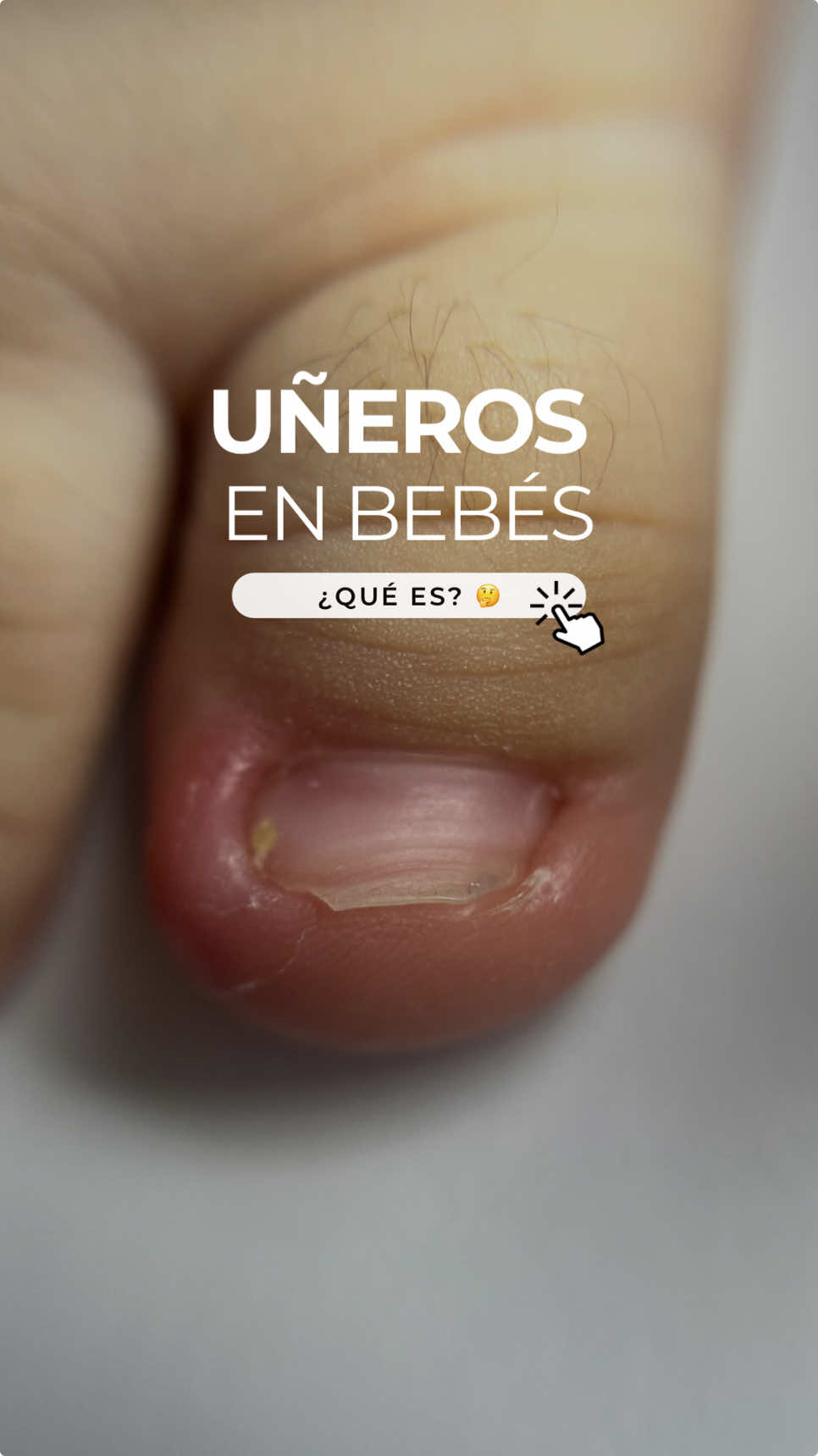 ¡Cuidado con los uñeros en bebés! 👶 Los uñeros pueden ser dolorosos y incómodos para tus pequeños. 💔 ¿Sabías que se forman por: ✨ Mal corte de uñas ✨ Fricción de los pies con medias y zapatos ¡Previéntelos con estos consejos! ✨ Corta las uñas de manera correcta ✨ Evita zapatos en bebés que aún no caminan ✨ Utiliza medias suaves y transpirables ¡Cuida los pies de tus bebés! 👣 #UñerosEnBebés #CuidadoInfantil #Prevención 