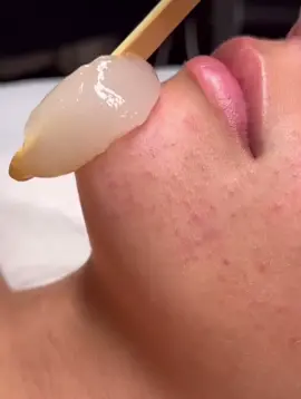 ✨ The Oxygen Facial ✨                                                        A customised oxygen treatment that generates CO2 bubbles which gently burst on the skin's surface to oxygenate, exfoliate and rejuvenate the skin!