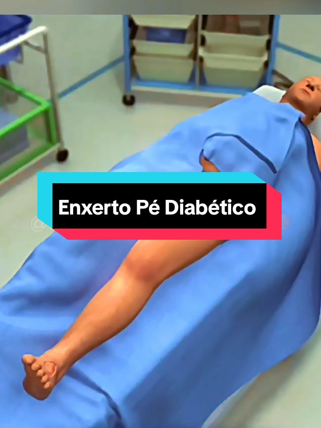 Enxerto para pé Diabético.. #cirurgia #medicina #saude #anatomia #diabetes 