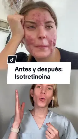 #dúo con @dalilaiovino_ La isotretinoina SALVA VIDAS. ¿La conocen? #skincare #acne 