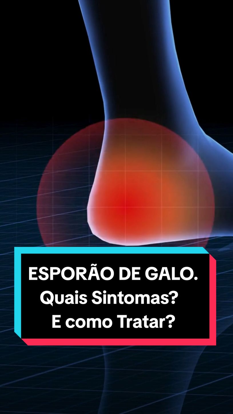 ESPORÃO DE GALO. Quais Sintomas e como Tratar.#esporaodegalo #esporaodecalcaneo #dor