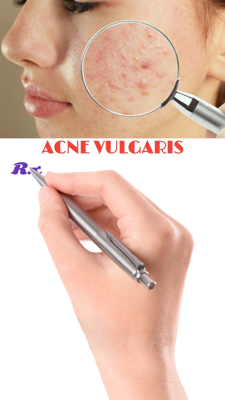 ACNE VULGARIS #TREATMENT #treatment #pharmacare10k #repost #1millionaudition #1mfollowers #unfrezzmyaccount #deartiktokteamdontunderviewmyvideos #pharmacare10k #medication #medicinetiktok #viralvideo #medicalstudent #medicineexplained @tiktok creators 