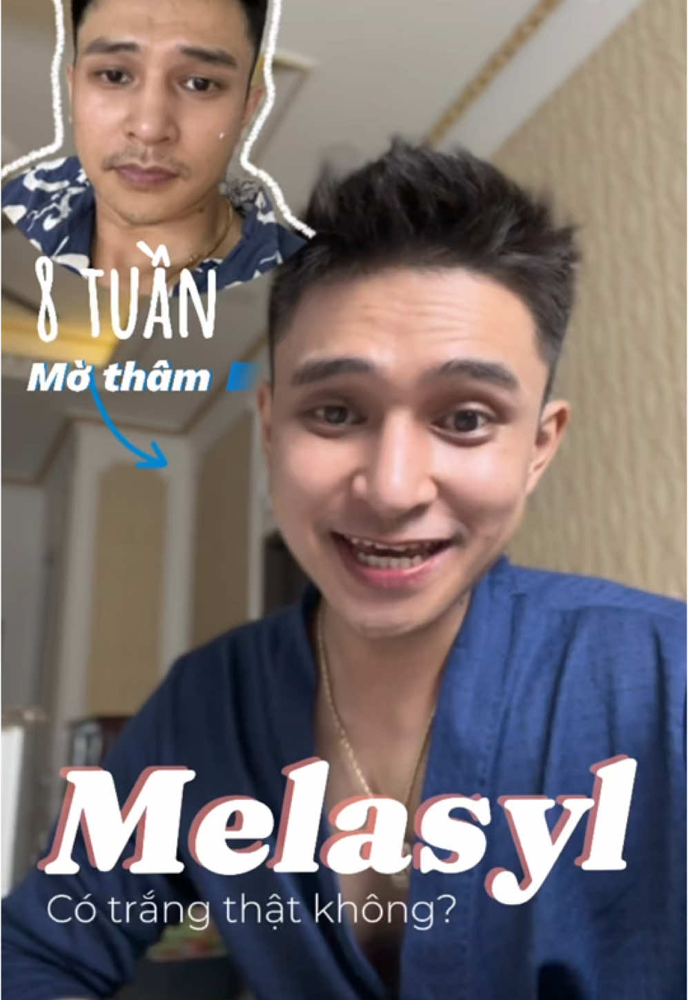 Sau 8 tuần dưỡng trắng với Melasyl #motham #trangda #thammun #serummelasylhong #lorealparis #minhtuanne 