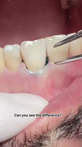Retraction cord #dentist #dental #dentista 