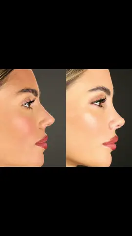 🎉✨ The Big Reveal Moment! ✨🎉 It’s been only two weeks since our amazing collaboration with @Enna Schell rhinoplasty, and today she’s seeing her new nose with Dr. Newman for the first time! Her reaction says it all—she’s over the moon! 🌙💖  Watching our patients light up when they see their results is truly the best part of what we do. Enna’s confidence is shining, and we’re so thrilled to be part of her journey! Rhinoplasty can be life-changing, and we’re here to help you feel like the best version of yourself. 💫 Ready for your own transformation? 📲 Book a consultation with Dr. Newman and start your journey today at  951.698.3344!  #RhinoplastyReveal #NewmanPlasticSurgery #TemeculaRhinoplasty #Temecula #TransformationJourney #Murrieta #SelfLove #BeforeAndAfter #PlasticSurgery
