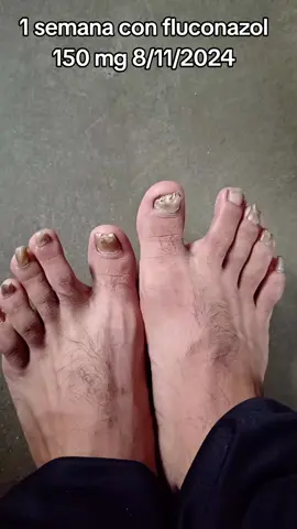 #uñas #fluconazol #onicogrifosis #curacion #parati 