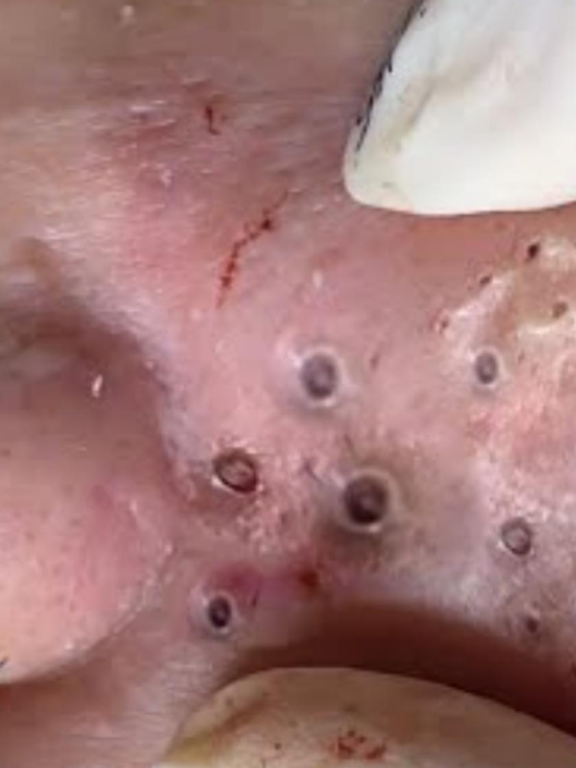 crazy Satisfying blackhead removed  #satisfyingvideo #satisfyingvideos #blackhead #blackheads #blackheadsremoval 