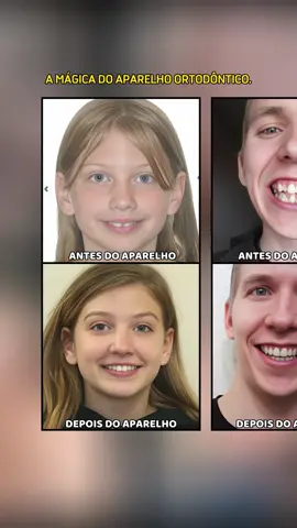 A mágica do aparelho Ortodôntico. #sorriso #dentista #autoestima #curiosidades #fyp #foryoupagе