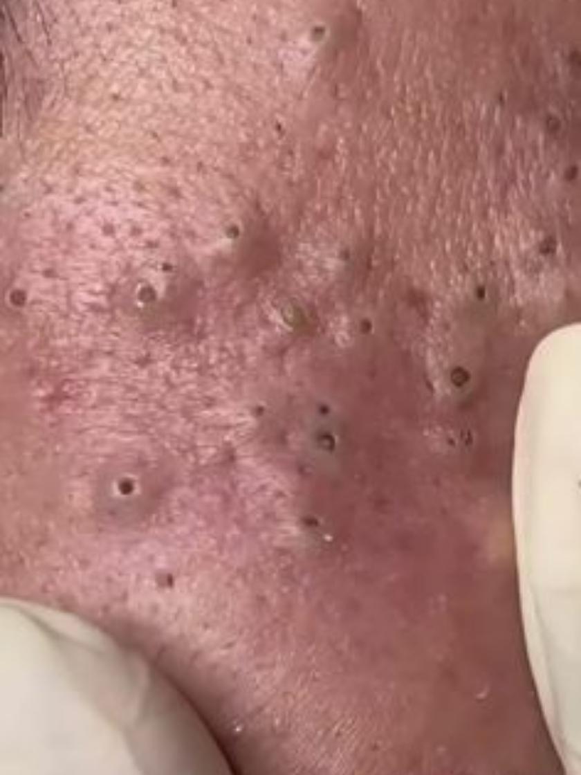 Crazy Satisfying blackhead removed  #blackheadsremoval #blackheads #blackhead #satisfyingvideos #satisfyingvideo 