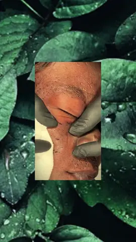 #squeezeyuk #satysfying #pimple #foryou #relax