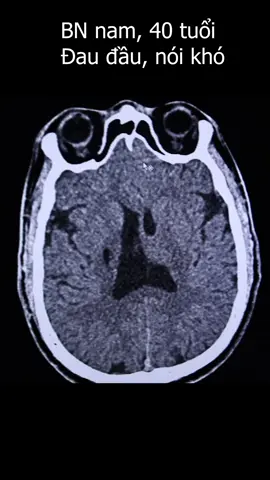 BN nam, mới 40 tuổi nhưng chụp CT phát hiện t.ổn thương như này! #ct #mri #suckhoe #suckhoelavang 